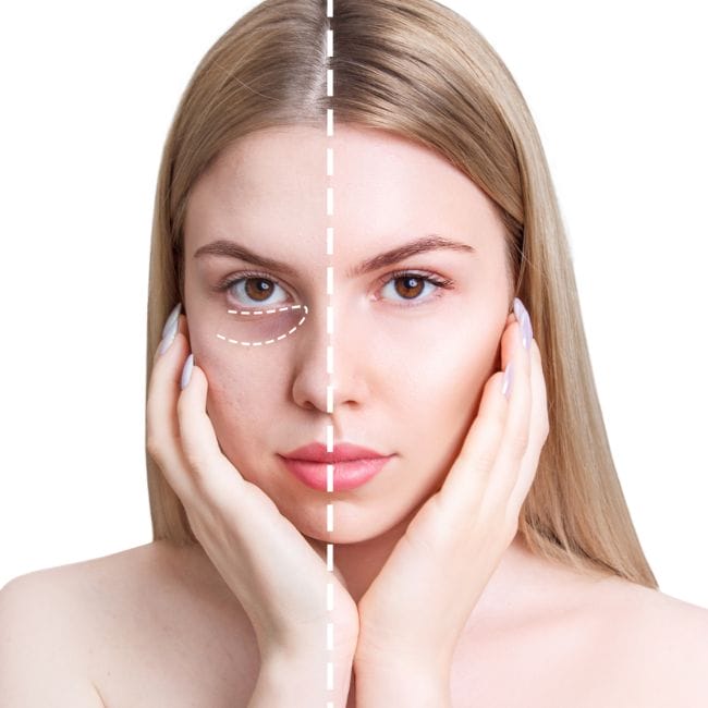 Liệu PRP, PRF hay các công nghệ trẻ hóa có hỗ trợ hốc mắt sâu không?