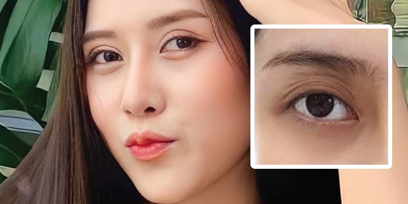 Lộ trình tối ưu thường thấy trong thực hành để trị hốc mắt sâu là gì?