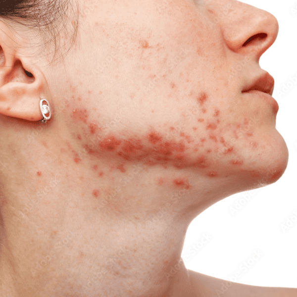 Mụn thâm khác gì với sẹo — làm sao biết mình thuộc loại nào?