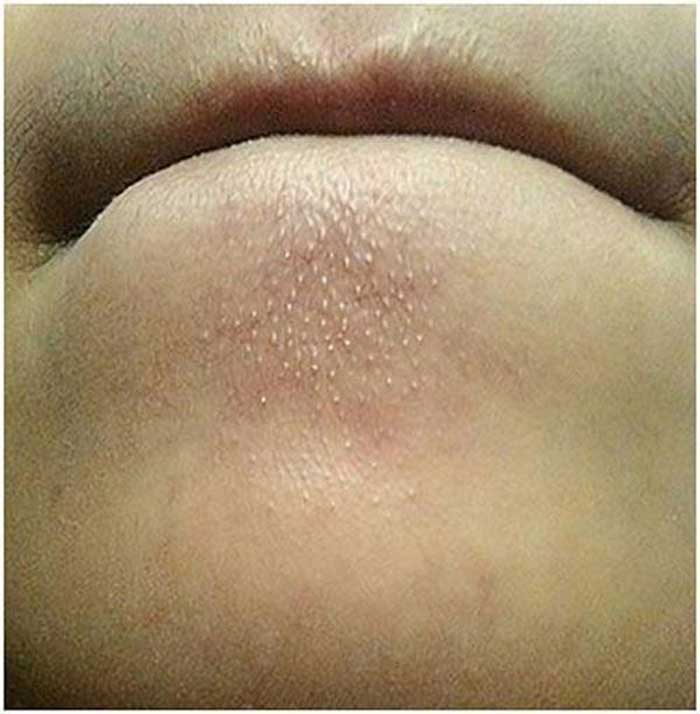 1. Kiểm soát mụn, giảm viêm là bước đầu tiên