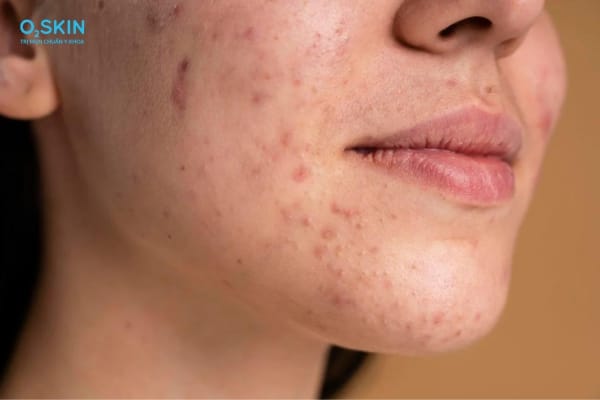 3. Peel hóa học và các liệu pháp tái tạo bề mặt