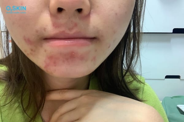 Làm sao chọn nơi điều trị an toàn cho mụn thâm dưới cằm?