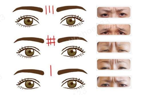 Cơ chế tác động – vì sao nếp nhăn mềm đi nhưng không biến mất vĩnh viễn?