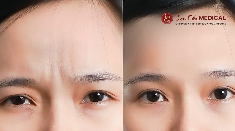 Filler axit hyaluronic — khi nào nên dùng?
