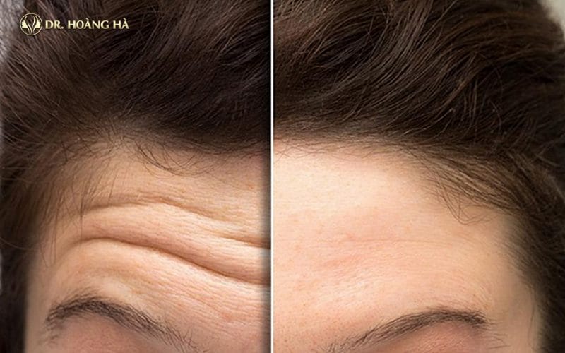 Tại sao nếp nhăn trên trán xuất hiện — có thể tác động ở nhà được không?