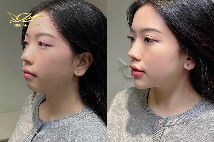 Tiêm filler cằm hoạt động theo cơ chế nào — tại sao có khác biệt giữa các loại filler?