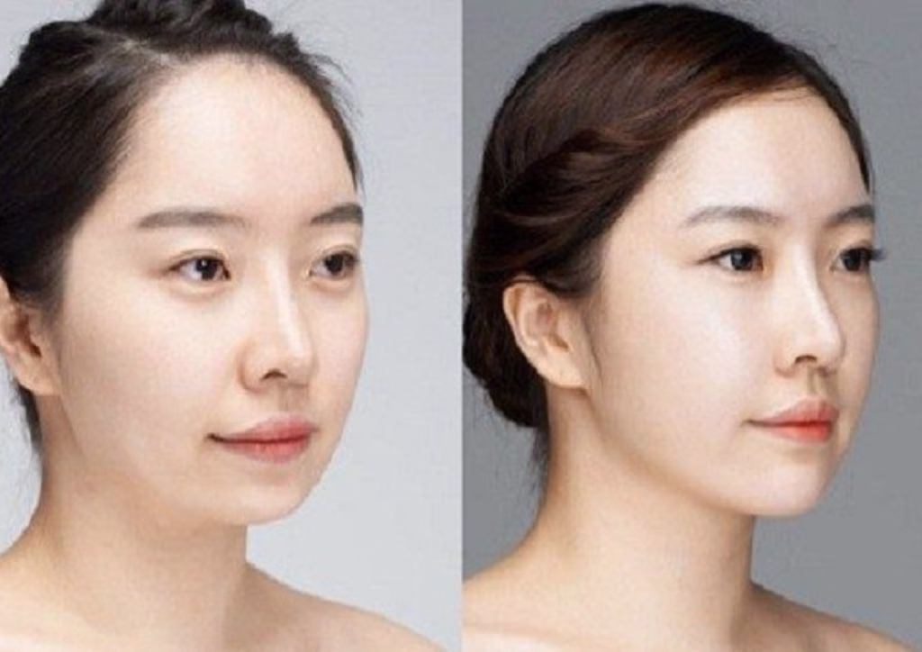 Biến chứng tiêm filler cằm: những dấu hiệu thường gặp và cách xử trí nhanh