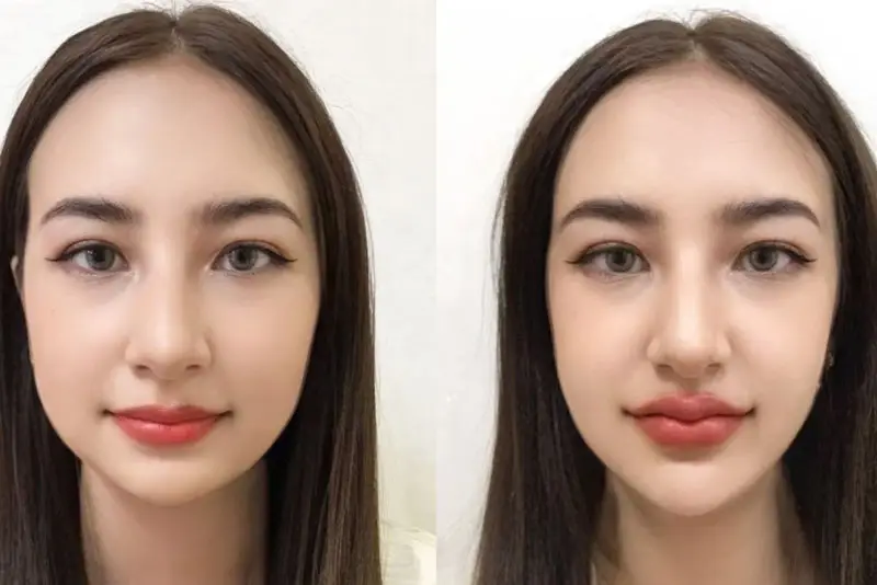 Lựa chọn filler nào và các thương hiệu được khuyến nghị tại thị trường Việt Nam?