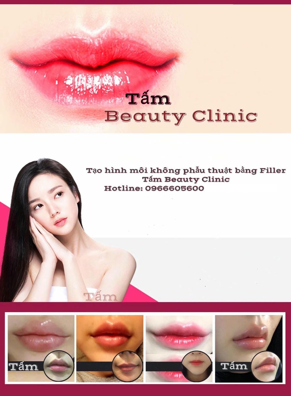 Filler môi hay cấy mỡ tự thân — phương pháp nào hợp lý?