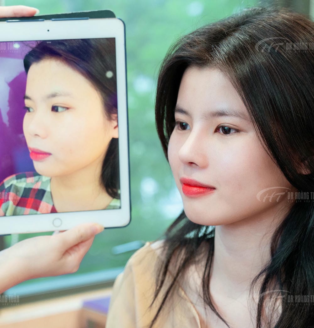 Các loại filler dùng để nâng mũi ở Việt Nam — hãng nào nên ưu tiên?