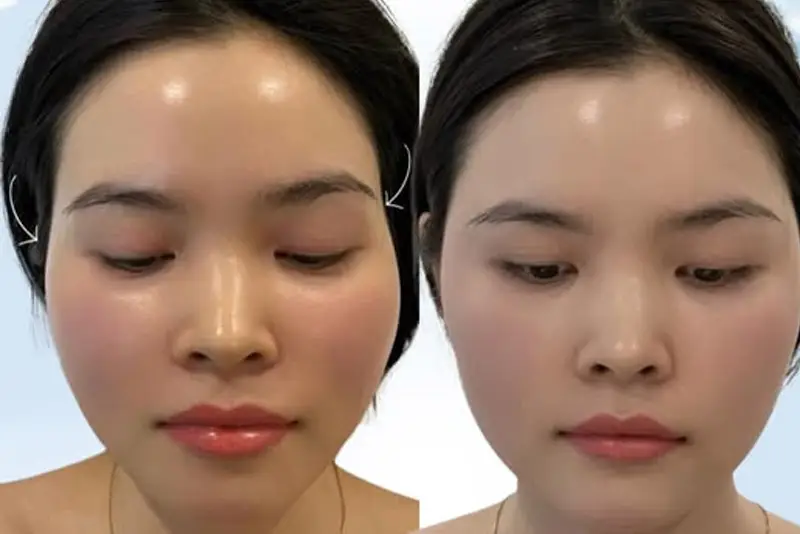 Tiêm filler thái dương có an toàn không — biến chứng nào cần đặc biệt lo ngại?