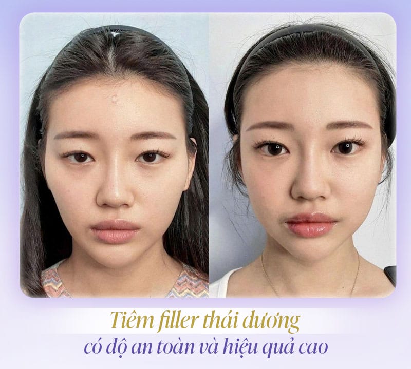 Tại sao vùng thái dương dễ có rủi ro — cơ chế giải thích thế nào?