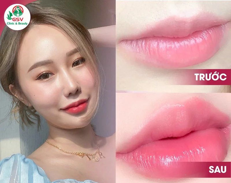 Tiêm môi mang lại lợi ích gì — hiệu quả kéo dài bao lâu?