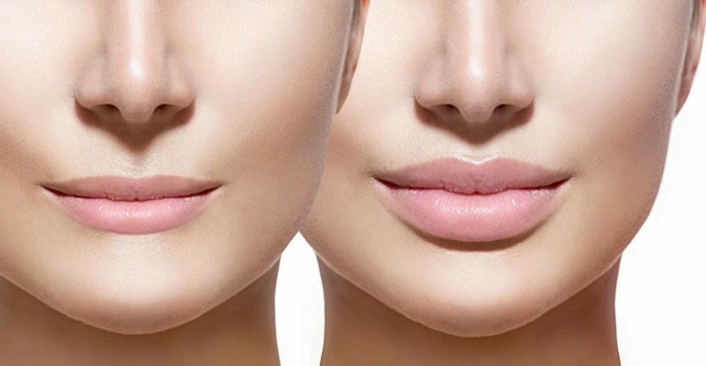 Phân biệt phản ứng bình thường và biến chứng tiêm môi cần can thiệp
