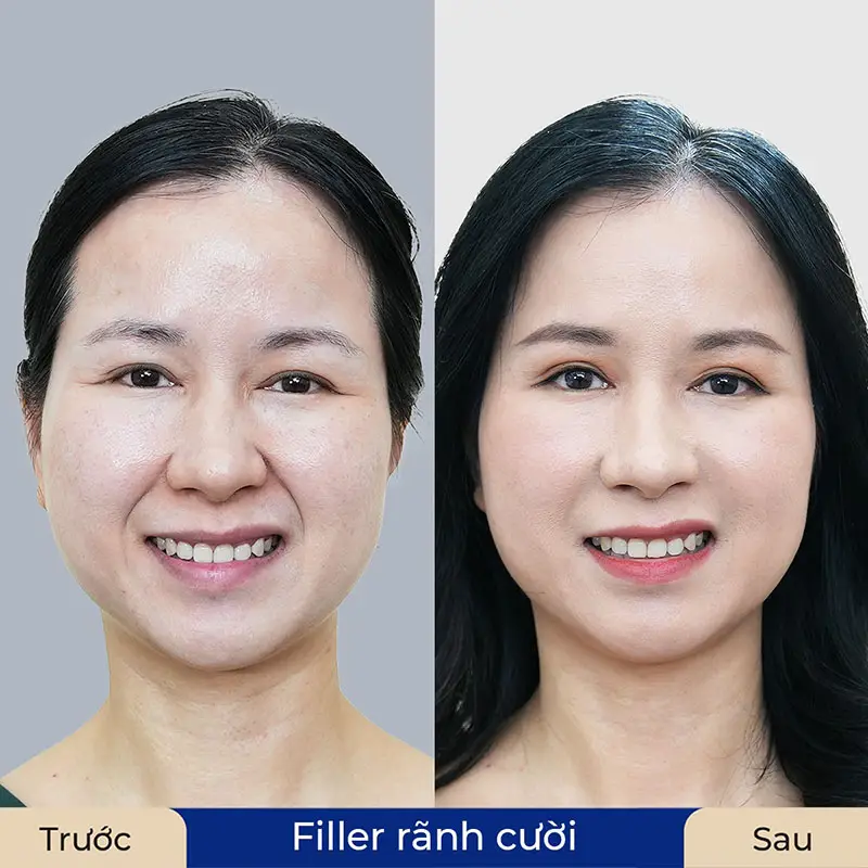 Tiêm trực tiếp vào rãnh cười: cơ chế và tác dụng