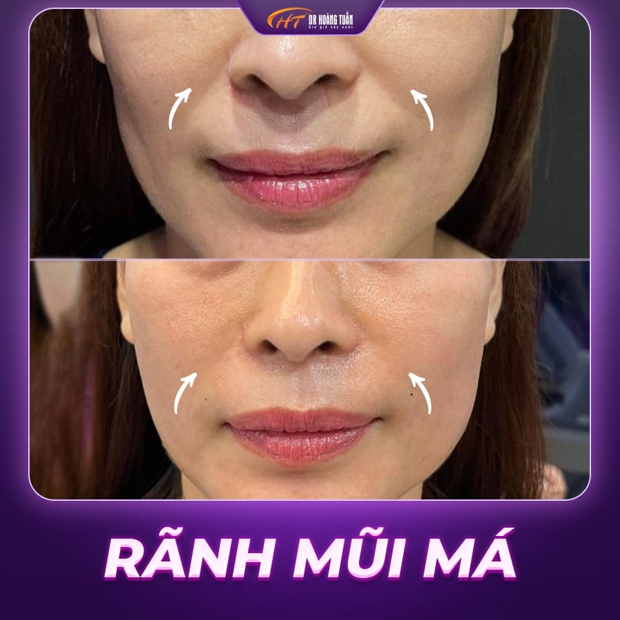 Làm đầy vùng má (cheek filler/malar)