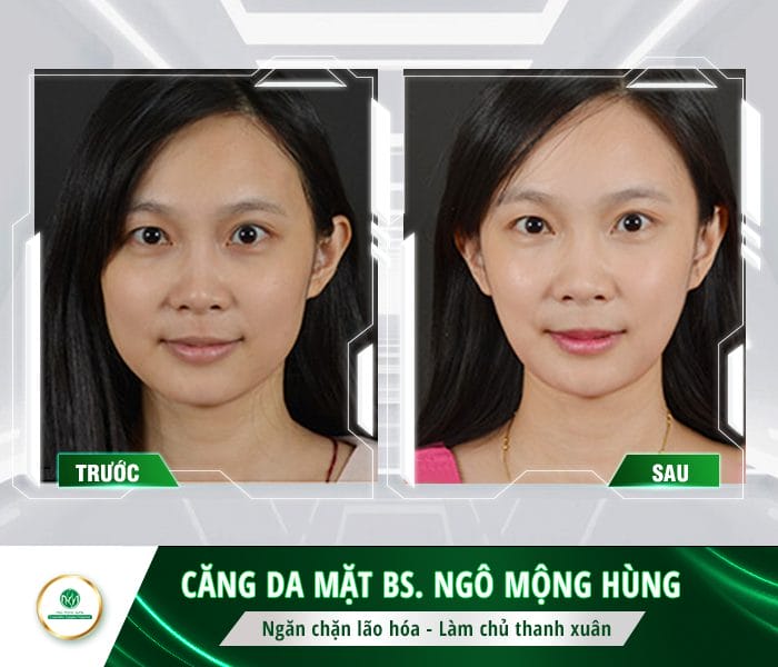 Cơ chế tác động của căng chỉ collagen — điều này ảnh hưởng thế nào tới việc kiêng cữ?