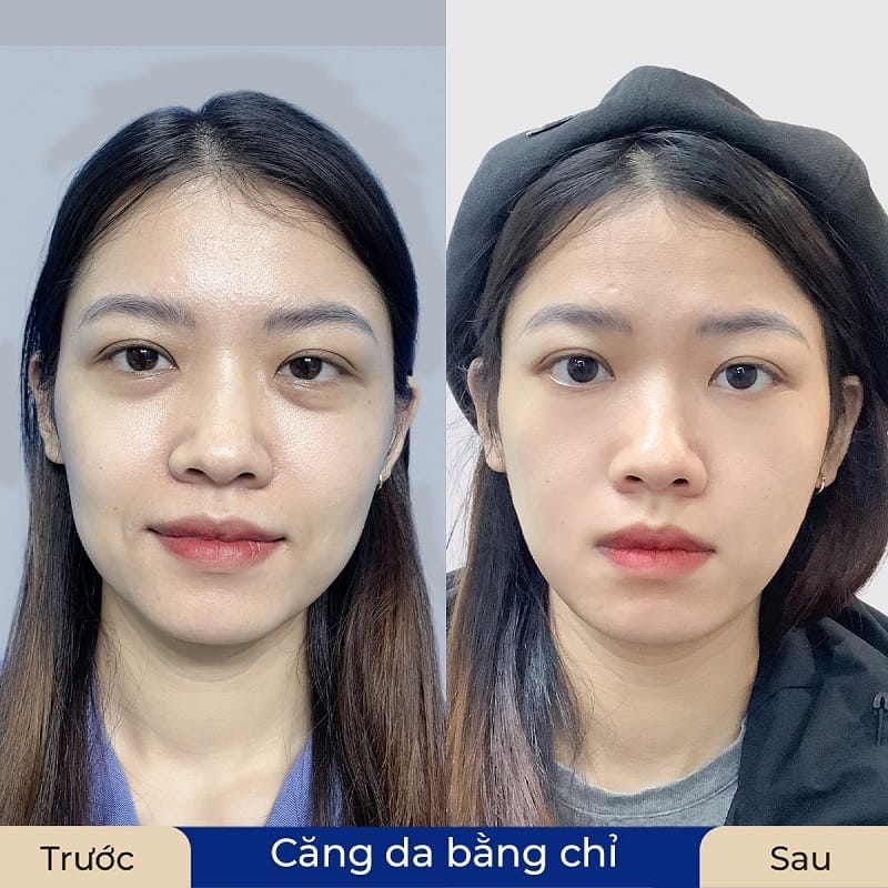 Khi nào có thể kết hợp với filler, laser hoặc HIFU?