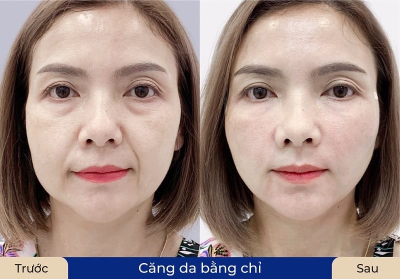 Thủ thuật có đau nhiều không và thời gian phục hồi là bao lâu?