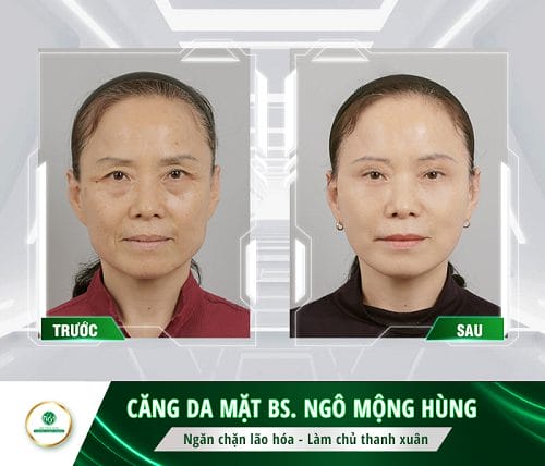 Nên kết hợp phương pháp nào để kết quả hài hòa, tự nhiên và lâu bền?