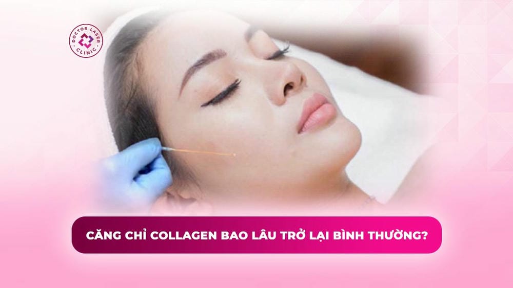 Các loại chỉ căng thường dùng — so sánh PDO PLLA PCL và vì sao loại nào bền hơn?