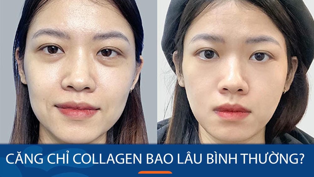 Quy trình căng chỉ diễn ra thế nào — có đau và nguy cơ gì không?
