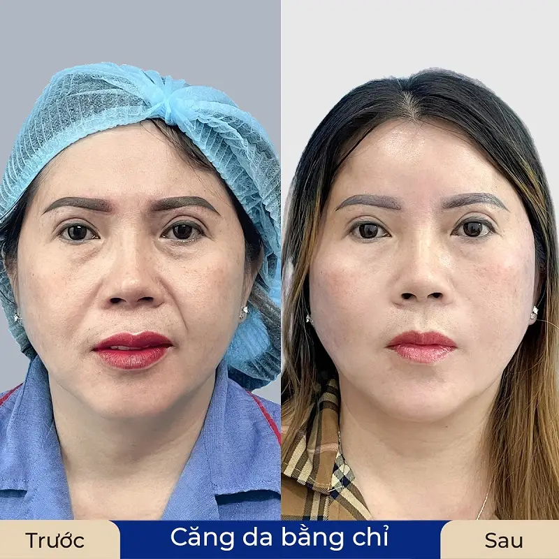 Chăm sóc sau căng chỉ để kéo dài hiệu quả như thế nào?