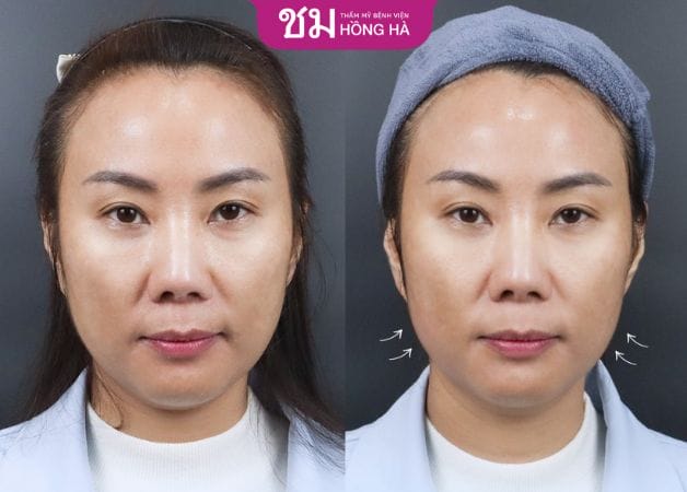 So sánh nhanh PDO, PLLA, PCL (điểm khác biệt chính)