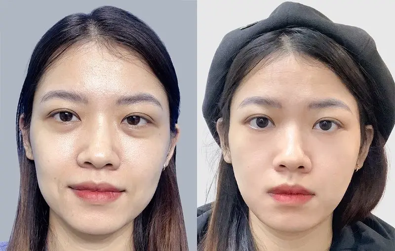 Quy trình một ca căng chỉ collagen thường diễn ra như thế nào?
