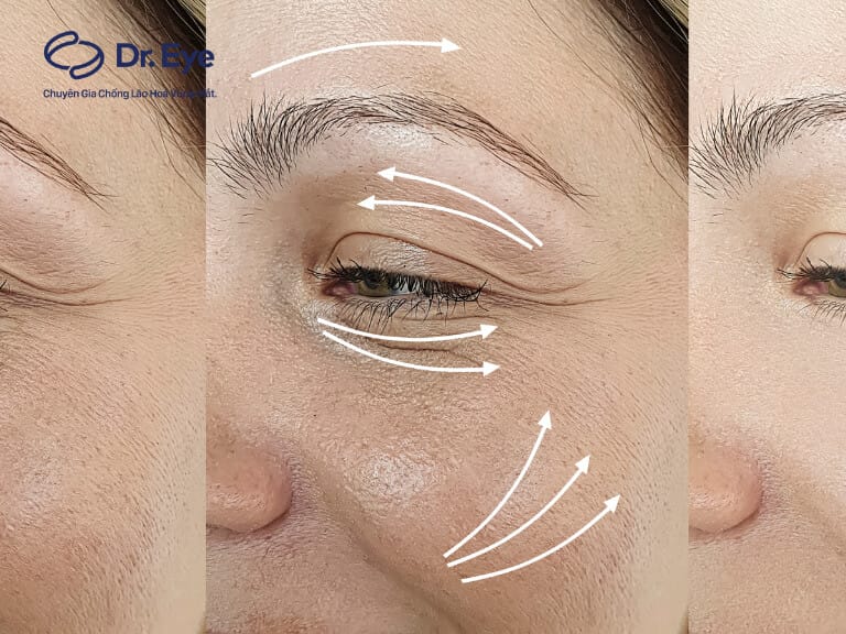 Căng chỉ collagen cho kết quả kéo dài bao lâu và cần làm lại không?
