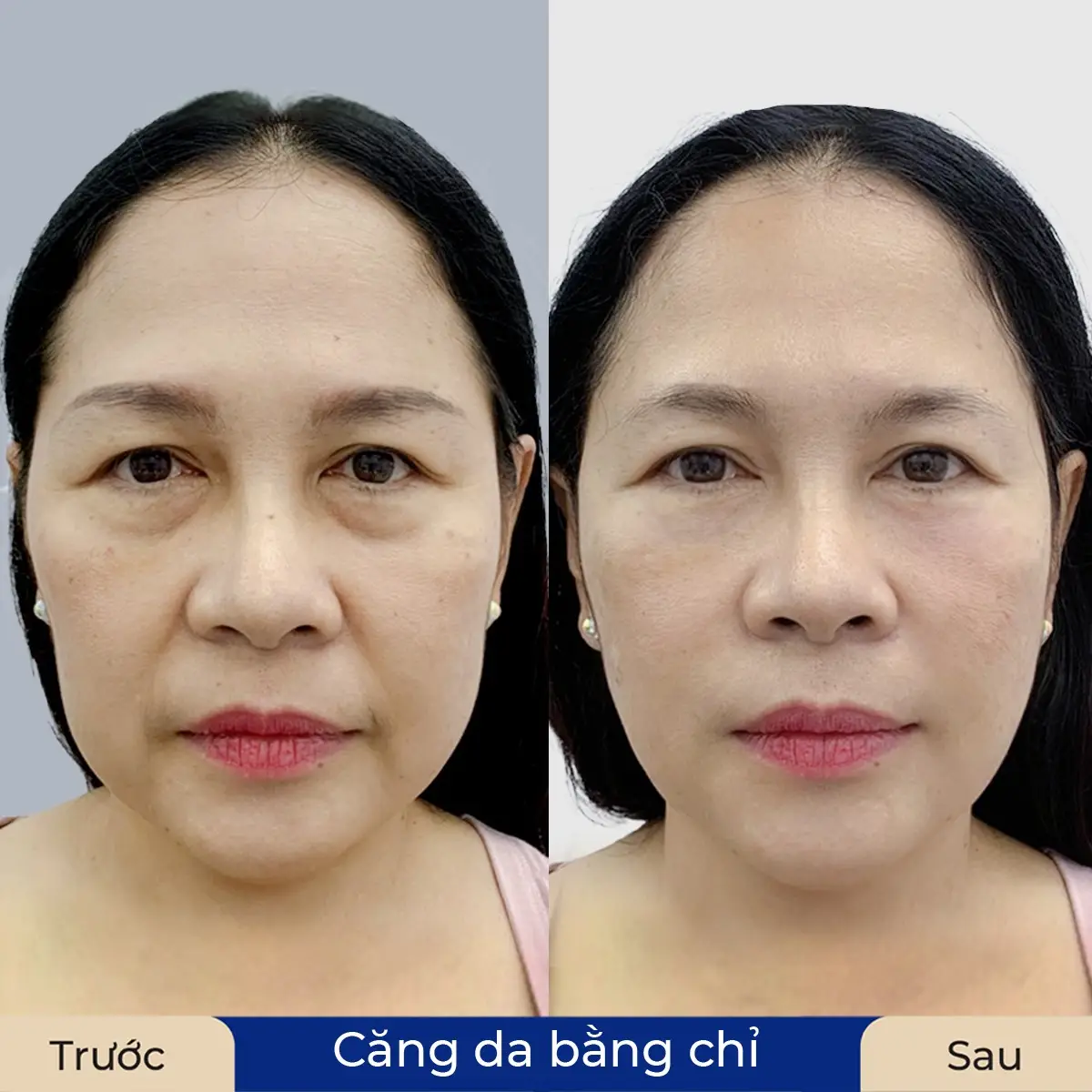 Ai là người phù hợp và những chống chỉ định cần biết?