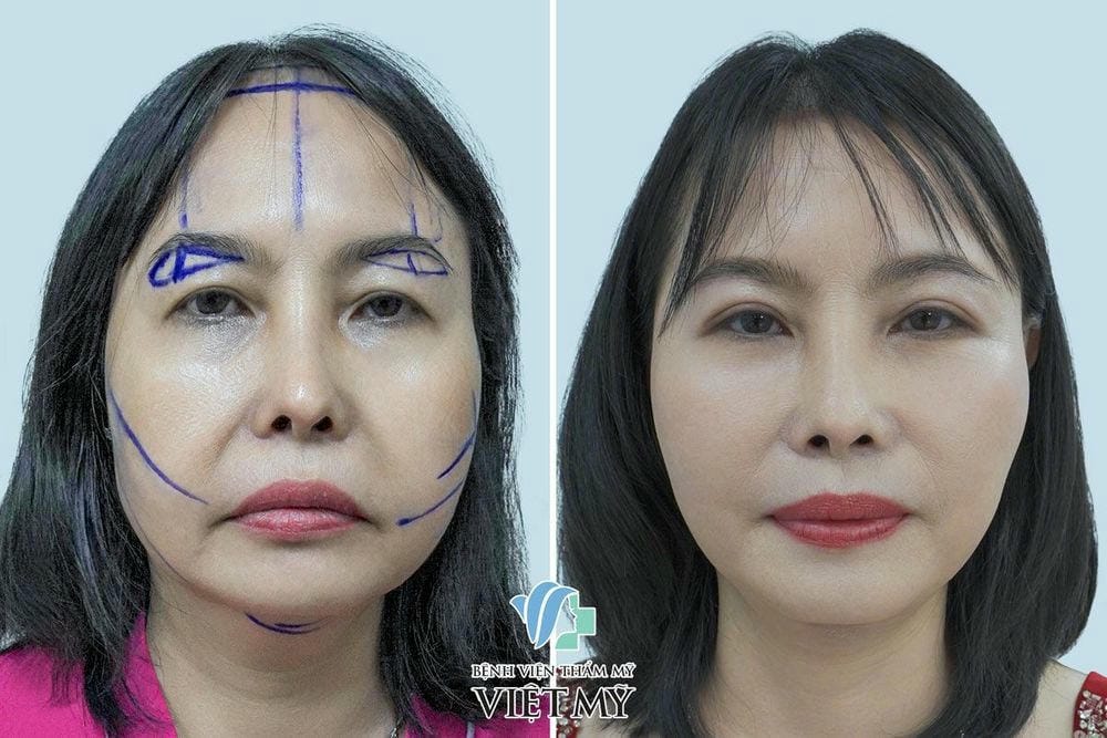 Tại sao nên chọn nội soi thay vì căng da truyền thống hoặc nâng bằng chỉ?