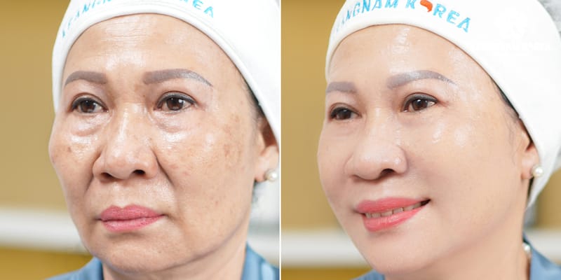 Có thể kết hợp những liệu pháp nào để nâng cao kết quả trẻ hóa?