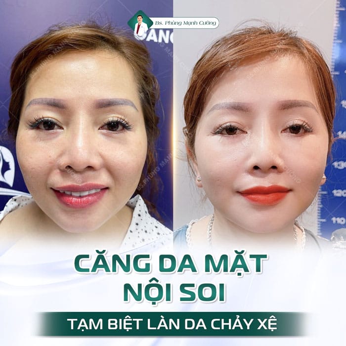 Căng da mặt nội soi phù hợp với độ tuổi nào?