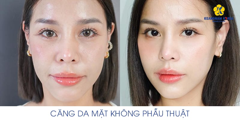 Filler và chất kích thích sinh học (biostimulators)