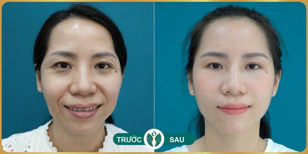 Ai phù hợp và ai không nên làm — có những chống chỉ định nào?