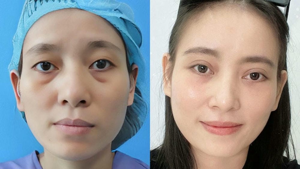 Sưng cấp và sưng kéo dài: bao lâu hết?