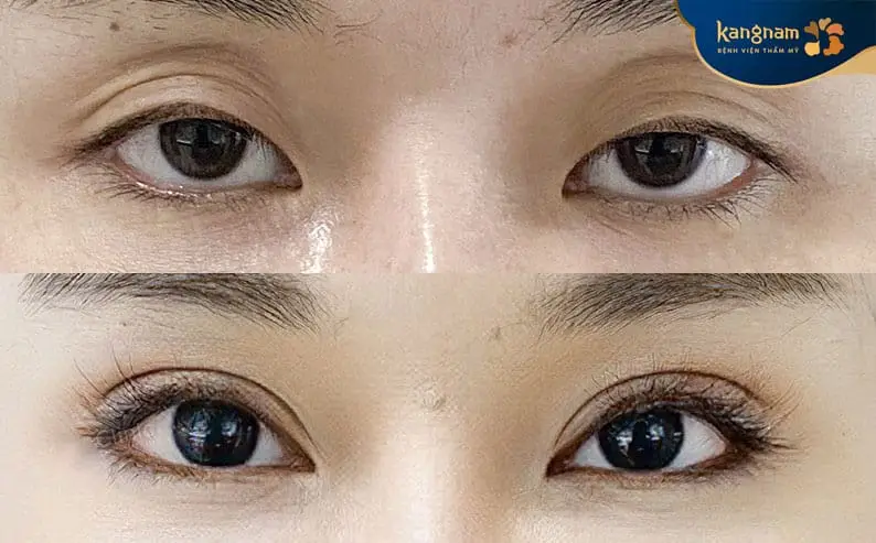 Cấy mỡ và tiêm filler: khác biệt về mức sưng và lựa chọn