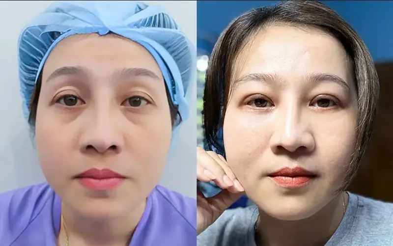 Quy trình thực hiện cấy mỡ hốc mắt dưới diễn ra như thế nào và cần chuẩn bị, chăm sóc ra sao?