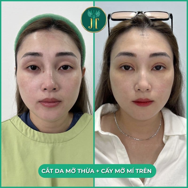 Bằng chứng lâm sàng và các cải tiến kỹ thuật gần đây có ảnh hưởng gì đến kết quả?