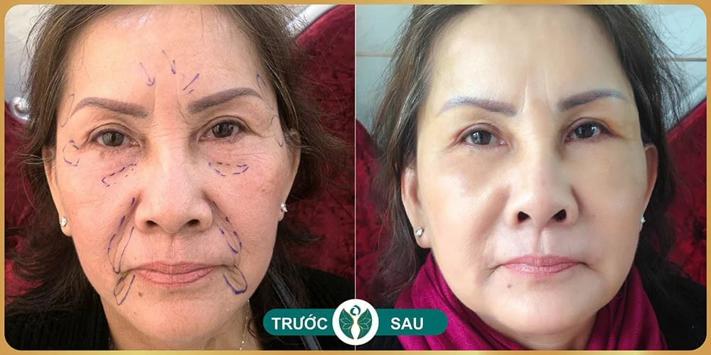 Cơ chế cấy mỡ hốc mắt dưới hoạt động như thế nào, độ bền và vai trò PRP vùng mắt?
