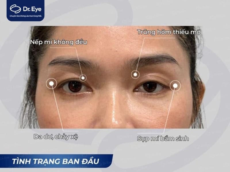 Chăm sóc sau cấy mỡ hốc mắt trên — lịch trình và lưu ý thực tế