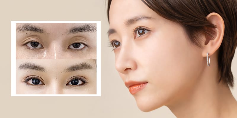 Thay thế và kết hợp: Khi nào cần kết hợp cấy mỡ với các thủ thuật khác?