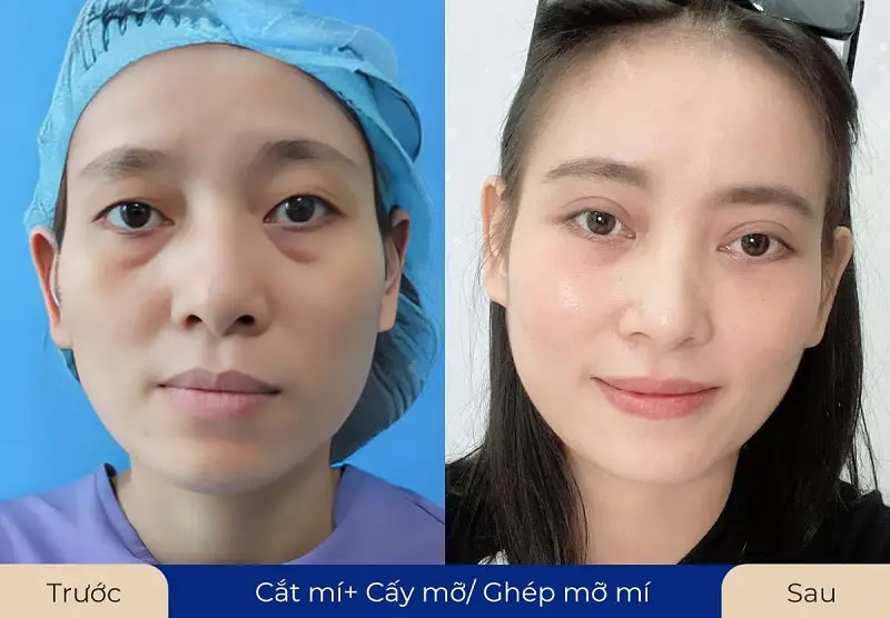 Ưu điểm của cấy mỡ