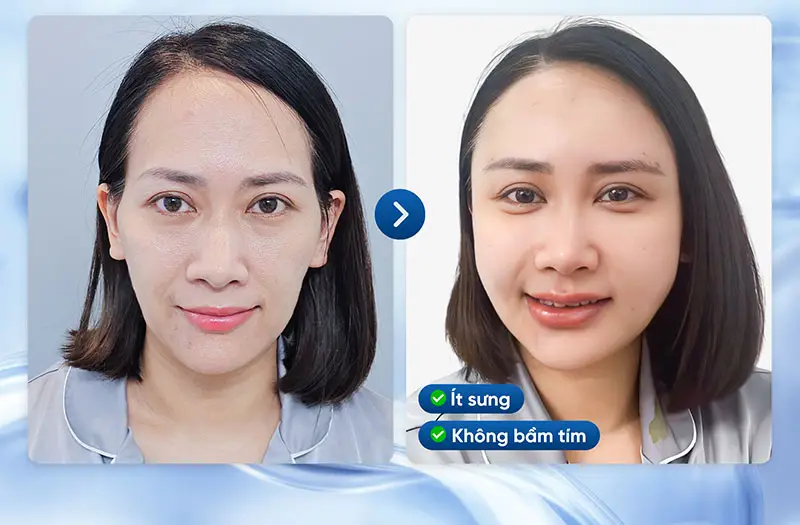 Tại sao có người hết sưng nhanh, có người sưng lâu?