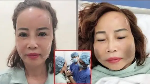 Làm sao để giảm sưng nhanh và an toàn sau cấy mỡ mặt (chăm sóc sau cấy mỡ)?