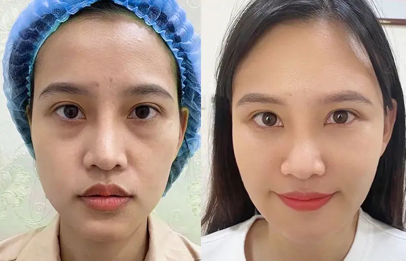 Sưng kéo dài hơn 3 tháng: khi nào cần lo và phải làm gì?