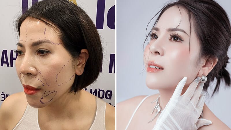 Cấy mỡ mặt và tiêm filler: cái nào sưng ít hơn và hồi phục nhanh hơn?