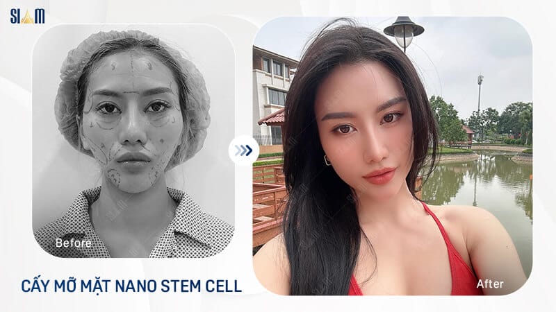 Quy trình cấy mỡ mặt điển hình và các mốc tái khám để theo dõi sưng