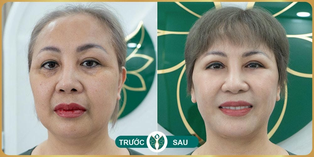 Tiêu chí chọn nơi cấy mỡ an toàn để giảm sưng kéo dài và biến chứng